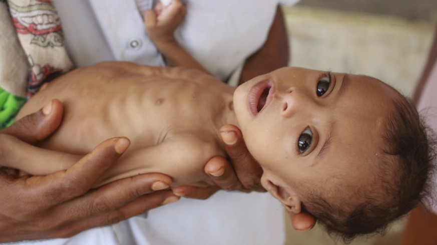 In this Sunday, June 14, 2020 photo, seven-month-old Issa Ibrahim Nasser is brought to a clinic in Deir Al-Hassi, At seven months old, Issa weighs only three kilos. Like him, hundreds of children suff ...