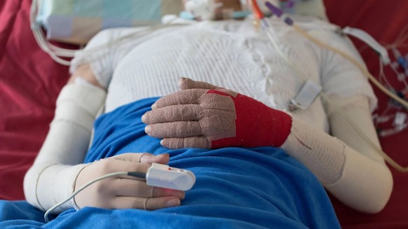 Eine brandverletzte Person liegt auf der Intensivstation.