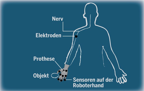 An den Muskeln des Armstumpfs sind kleine Elektroden angebracht, über die sich die motorisierte Armprothese steuern lässt. Eine Kunsthand der ETH Lausanne ermöglicht es sogar, wieder zu fühlen. Dafür  ...