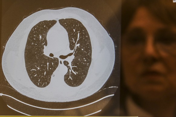 Die Lunge eines Covid-Patienten.