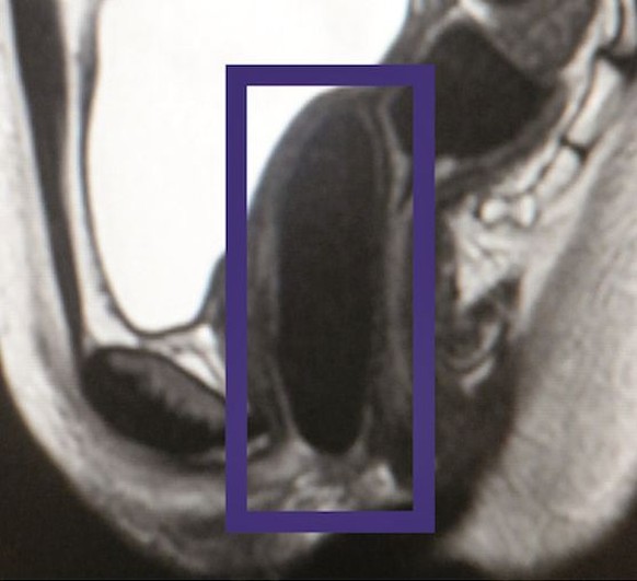 MRI-Aufnahme einer implantierten Vagina.&nbsp;
