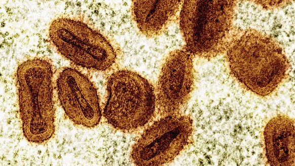FILE - This colorized electron microscope image provided by the National Institute of Allergy and Infectious Diseases in 2024 shows Mpox virus particles, orange, found within infected cells, green. (N ...