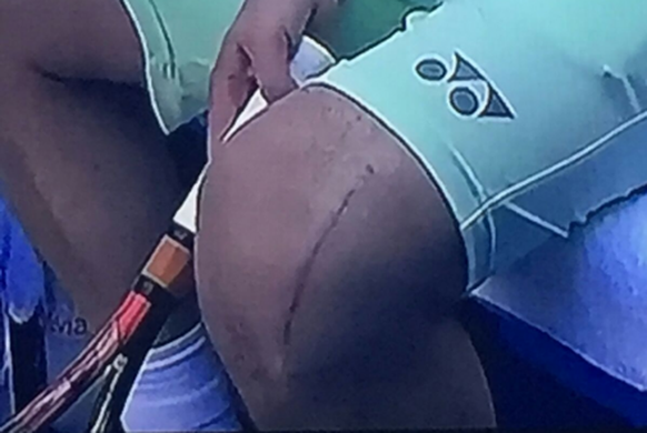 So sieht das Knie von Stan Wawrinka aus.