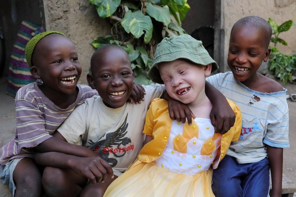 Albino Kind in Tansania