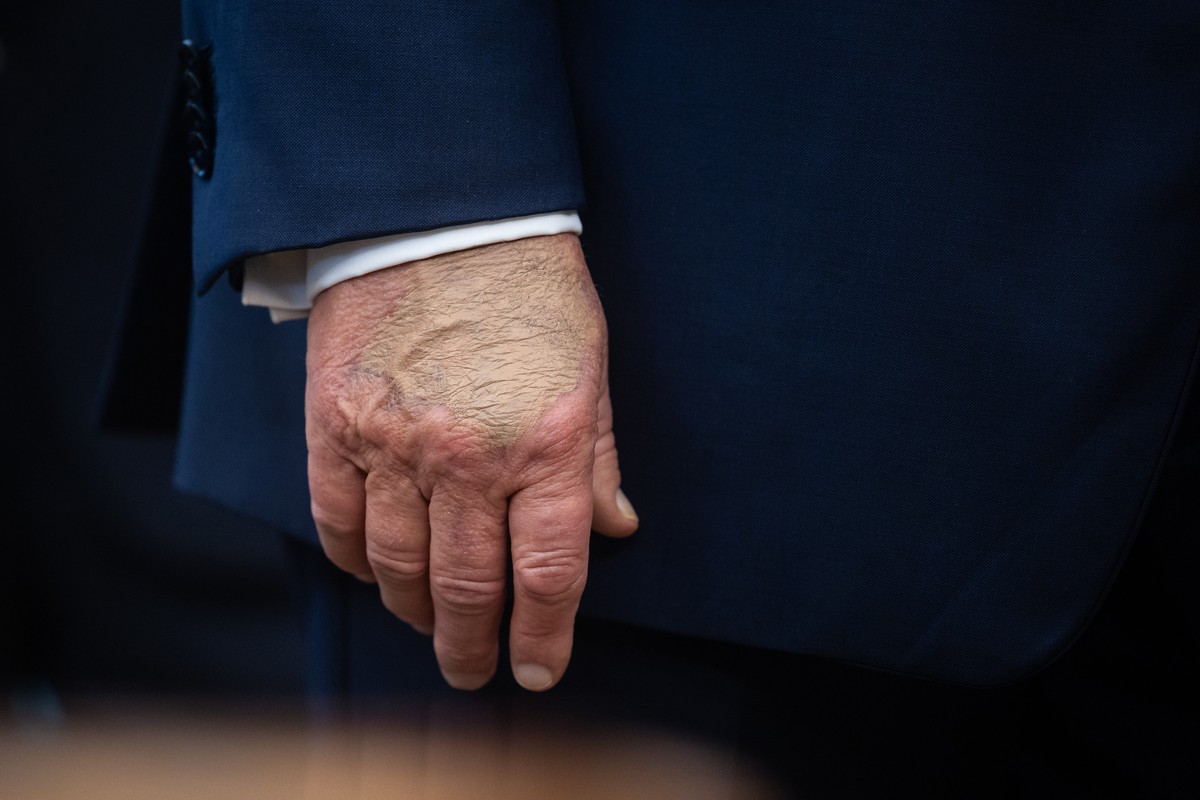 epa12417631 The right hand of US President Donald Trump is seen as he announces a drug-pricing deal with Pfizer in the Oval Office at the White House in Washington, DC, USA, 30 September 2025. EPA/FRA ...