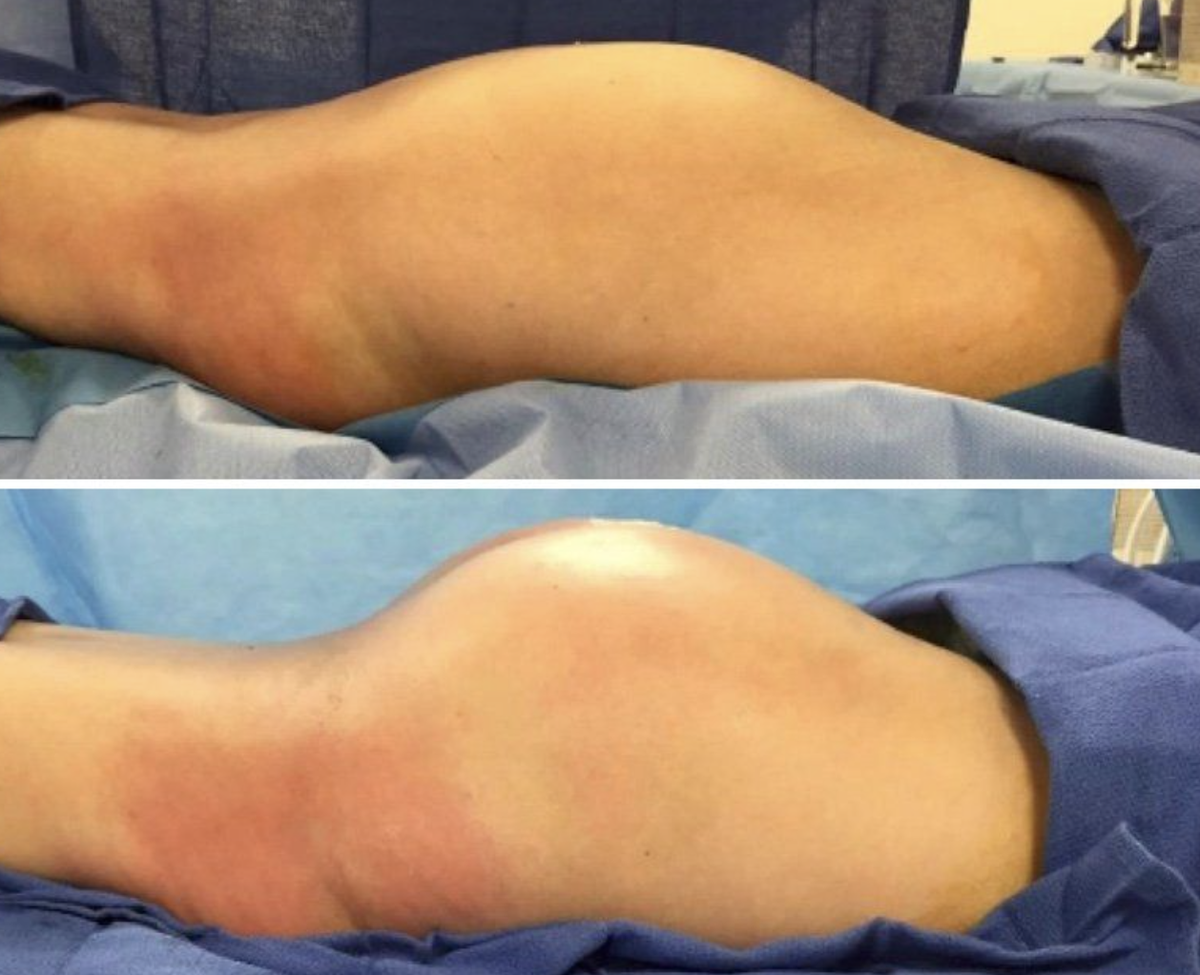 Eine Vorher-Nachher-Aufnahme. Die Behandlung wird in Normalfall ambulant durchgeführt und dauert rund zwei bis drei Stunden.