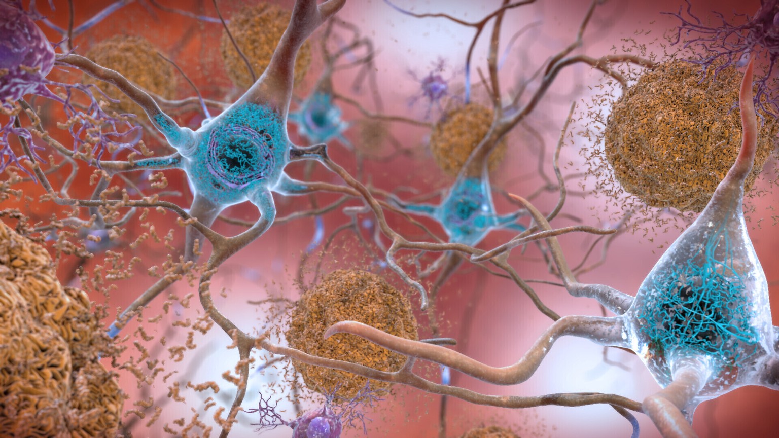 This illustration made available by the National Institute on Aging/National Institutes of Health depicts cells in an Alzheimer���s affected brain, with abnormal levels of the beta-amyloid protein clu ...