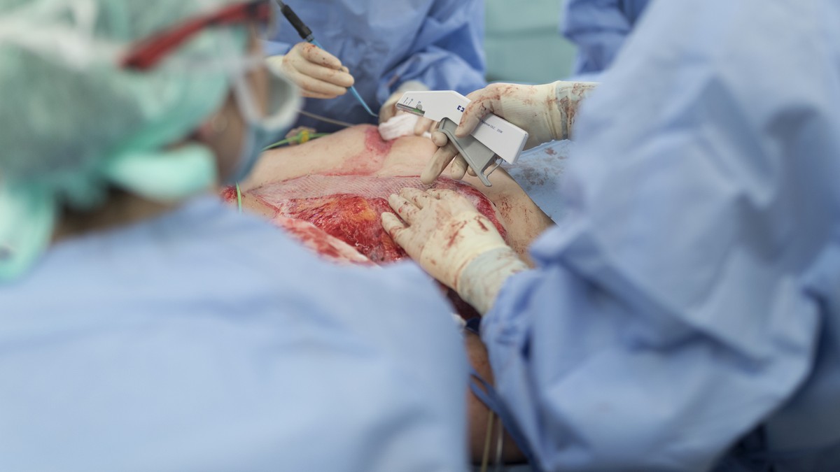 ZUR INTENSIVSTATION FUER BRANDVERLETZTE DES UNIVERSITAETSSPITALS ZUERICH STELLEN WIR IHNEN HEUTE, MITTWOCH, 8. FEBRUAR 2017, FOLGENDES NEUES BILDMATERIAL ZUR VERFUEGUNG --- [Editors Note: GRAPHIC CONT ...