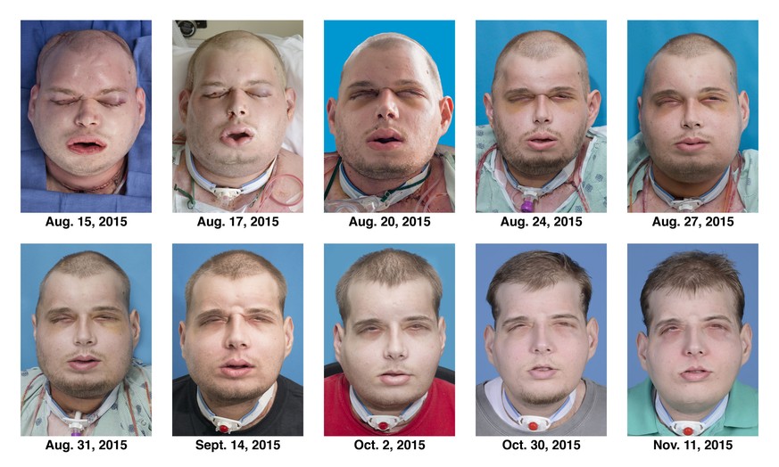 This combination of Aug. 15, 2015 to Nov. 11, 2015 photos provided by the New York University Langone Medical Center shows the recuperation of Patrick Hardison after his facial transplant surgery in N ...