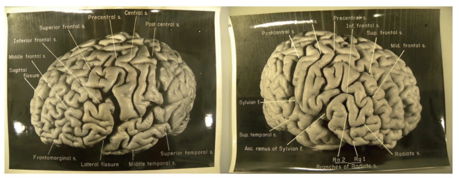 Einsteins Scheitellappen waren um 15 Prozent breiter als der Durchschnitt, seine Sylvische Fissur (horizontale Furche, die ungefähr in Augenhöhe auf beiden Seiten des Gehirns verläuft) war ungewöhnlic ...