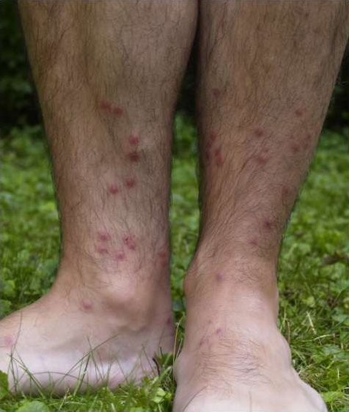 Des boutons de puces de canard sur des jambes