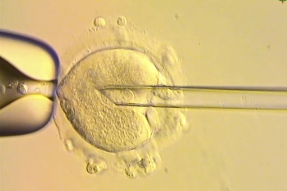 This image from video provided by the Newcastle Fertility Centre shows a nuclear genome from an egg carrying a mitochondrial DNA mutation being inserted into an egg donated by an unaffected woman. (Ne ...