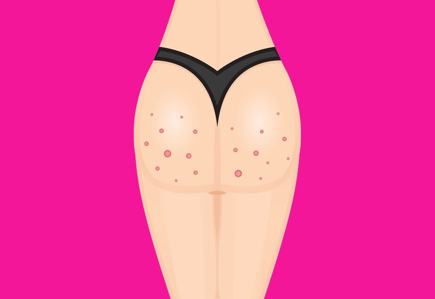Buttocks, breech, butt, rear, pimple, acne
