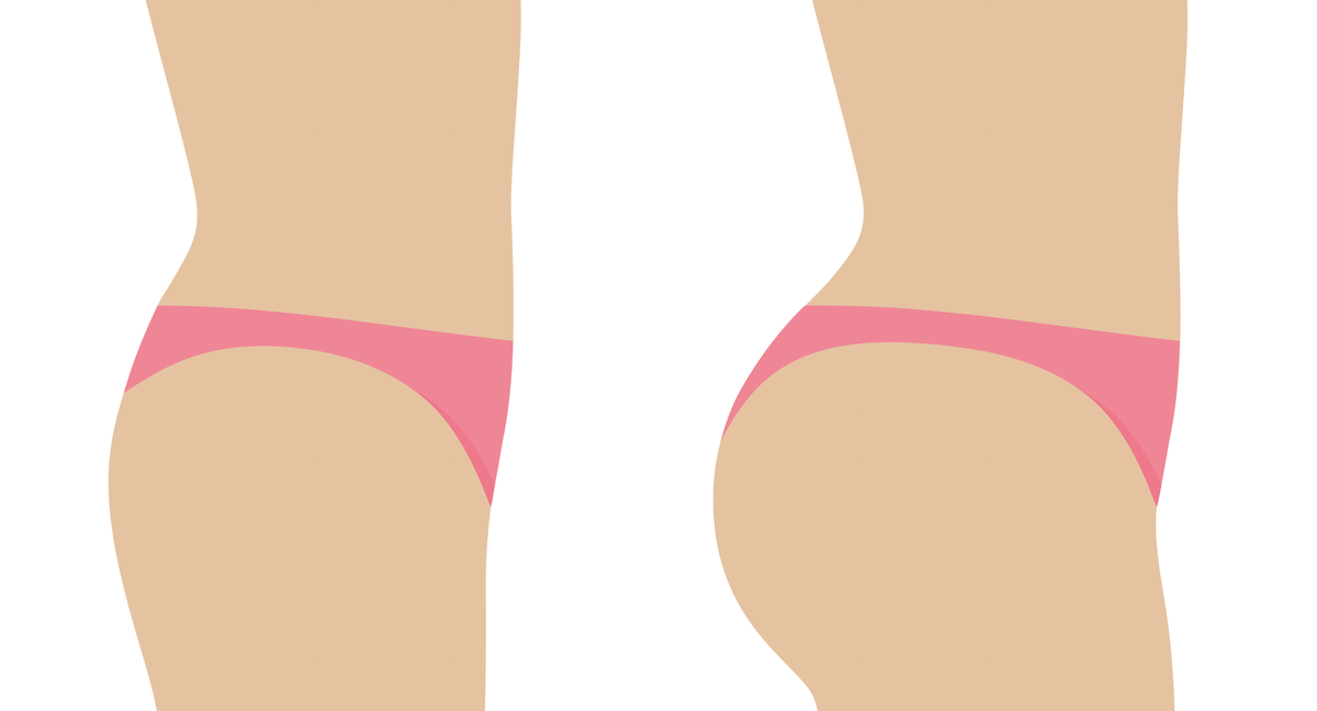 Ein Brazilian Butt Lift (BBL) ist ein chirugirischer Eingriff zum Zweck einer Po-Vergrösserung.
