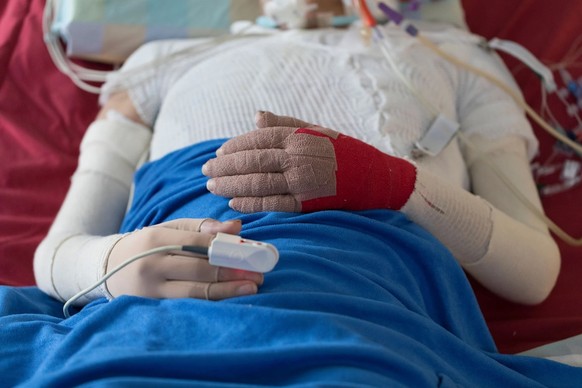 Eine brandverletzte Person liegt auf der Intensivstation.