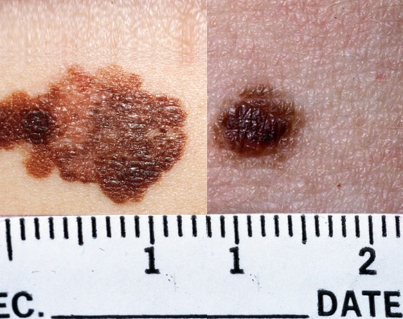 Eine darauf trainierte KI kann schwarzen Hautkrebs von einem Muttermal unterscheiden