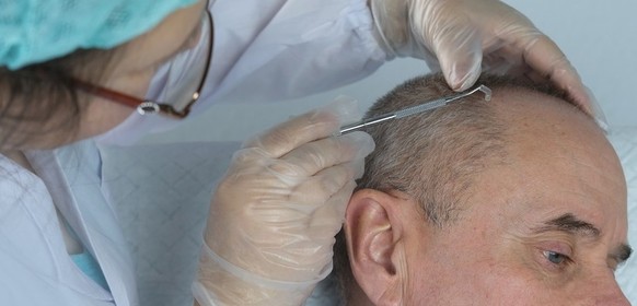 Haartransplatation
