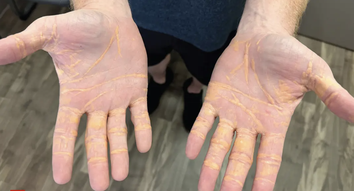 L'homme a été admis à l'hôpital de Tampa (FL) avec des nodules jaunâtres suintant sur la paume de ses mains, ses coudes et la plante de ses pieds.
