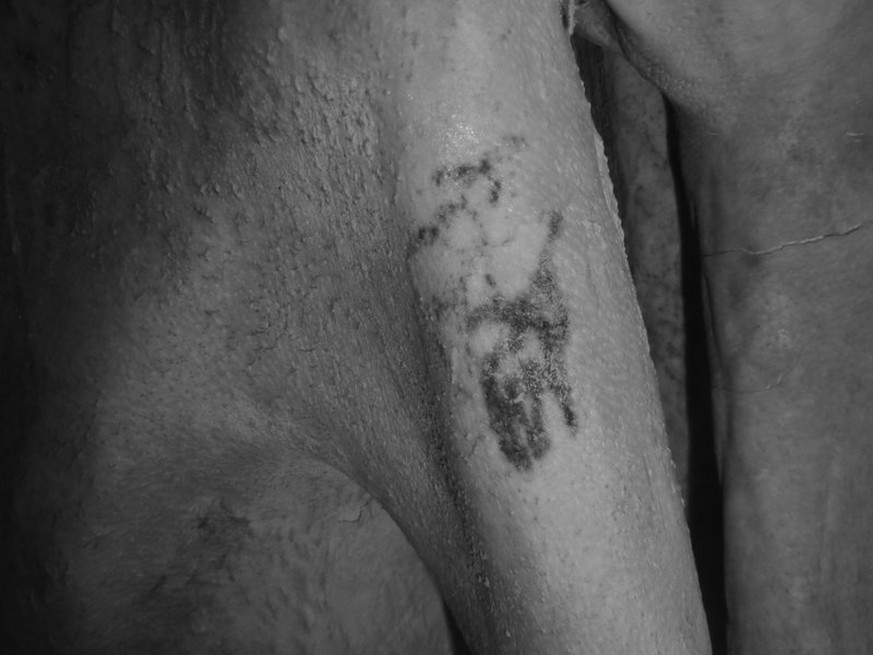 Tattoos auf ägyptischen Mumien der prädynastischen Zeit, Gebelein-Mann-A