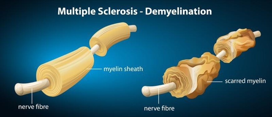 Bei Multipler Sklerose greift das Immunsystem die Myelinscheiden an den Nervenzell-Fortsätzen an (r.), was zu einer Vielzahl von neurologischen Schäden führen kann. 
