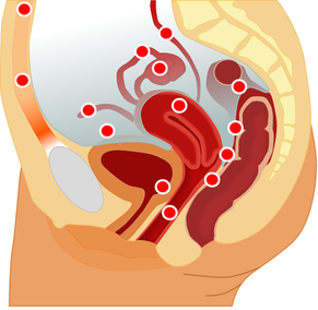 Mögliche Endometrioselokalisationen.