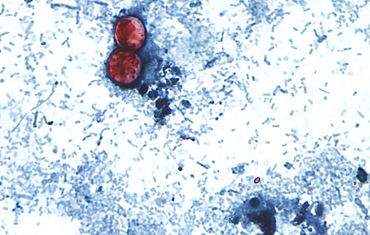 This undated photo taken through a microscope provided by the CDC shows Cyclospora cayetanensis oocysts found in a fresh stool sample which had been prepared with a formalin solution and stained with  ...