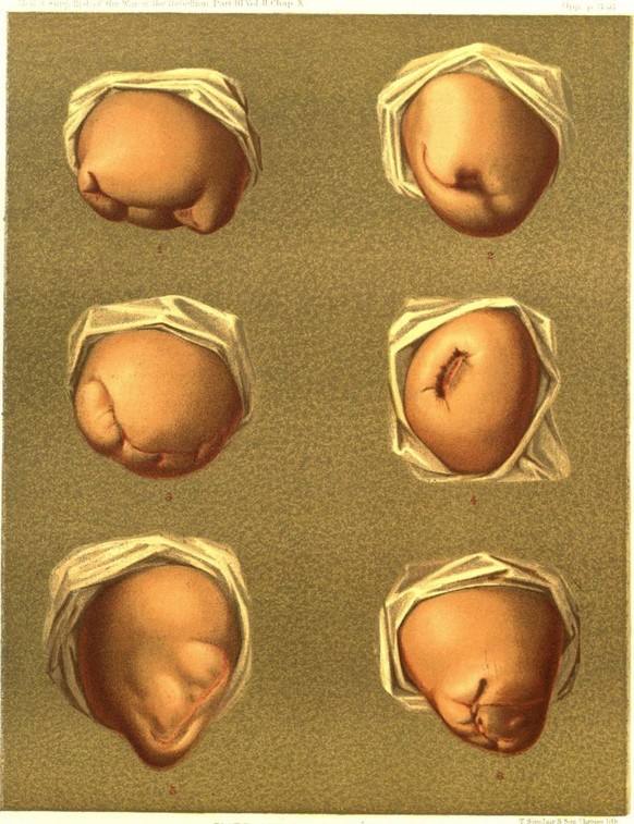 Color print depicting six images of the stumps remaining after human thighs were amputated, numbered 1-6 to indicate the amputation style, by anterior flap, posterior flap, anterior-posterior flaps, c ...